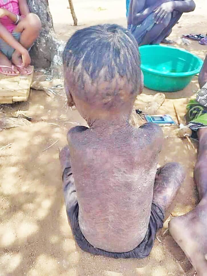 Image à la une de MALADIE CONTAGIEUSE – La gale sévit à Ampanihy Andrefana