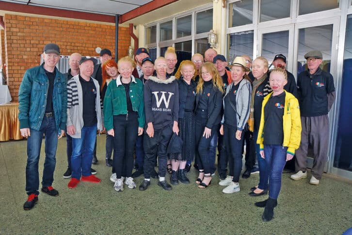Image à la une de DISCRIMINATION – La protection des albinos progresse