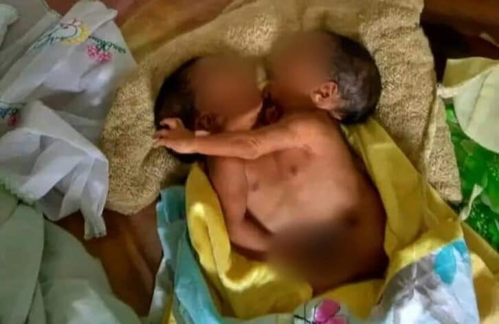 Image à la une de MATERNITÉ – Naissance de deux sœurs siamoises à Vohémar