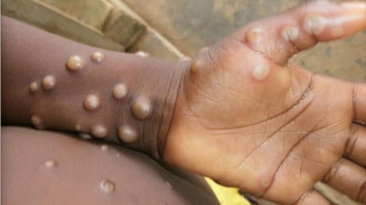 Image à la une de ÉPIDÉMIE DE MPOX – L’OMS déclare une urgence sanitaire mondiale