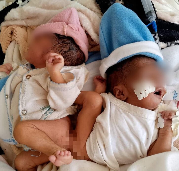 Image à la une de ACCOUCHEMENT PARTICULIER – Des bébés siamois naissent sur la route