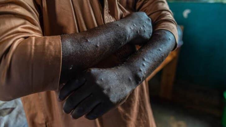 Image à la une de Sierra Leone: plus de 1.100 cas de mpox recensés et 9 décès, selon les autorités