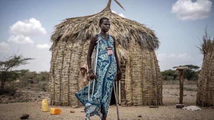 Image à la une de Au nord du Kenya, le dramatique impact du mycétome, et son cortège d’amputations