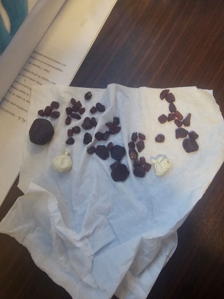 Image à la une de TRAFIC – 54 pièces de rubis de 59,3 grammes dissimulés dans le rectum d’un passager interceptés à l’aéroport d’Ivato